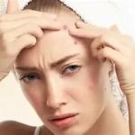 Cara Mengatasi Jerawat Batu yang Membandel