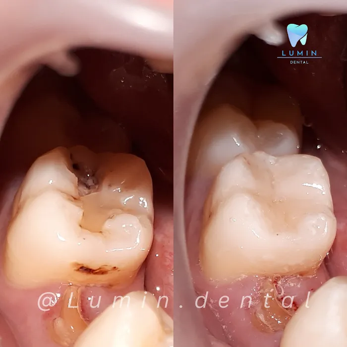 LUMIN DENTAL KLINIK GIGI & PRAKTEK DOKTER GIGI PALEMBANG Picture 9