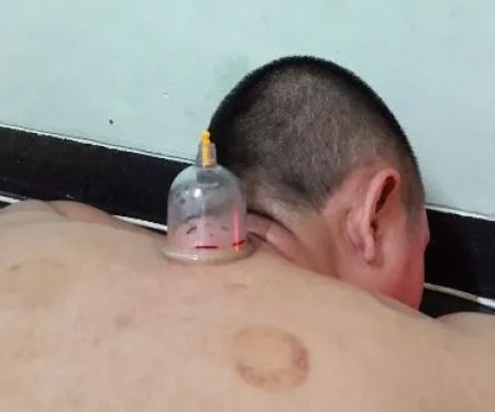 Bekam sehat