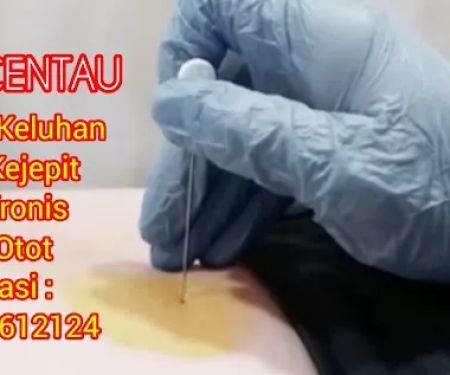 Terapi Syaraf Kejepit Akupuntur Centau Tabib Roy