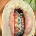 Dokter Gigi Terdekat Edental | Pasang Behel Gigi Palembang Plaju