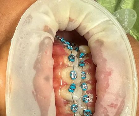 Dokter Gigi Terdekat Edental | Pasang Behel Gigi Palembang Plaju