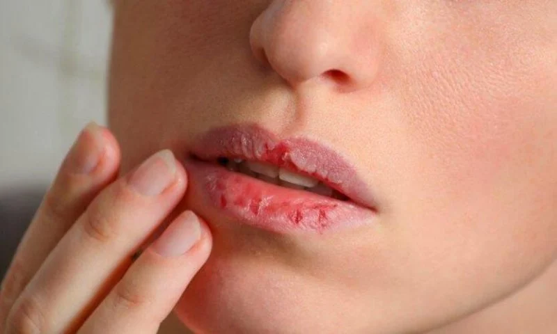 Penyebab Bibir Kering dan Pecah Pecah Serta Cara Mengatasinya