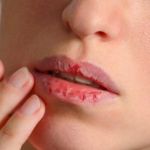 Penyebab Bibir Kering dan Pecah Pecah Serta Cara Mengatasinya