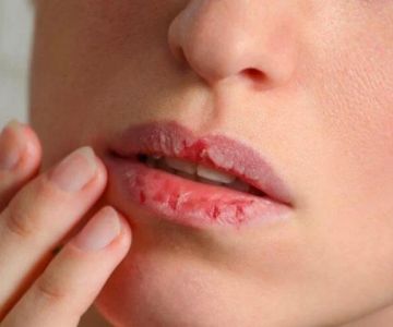 Penyebab Bibir Kering dan Pecah Pecah Serta Cara Mengatasinya